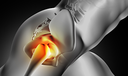 ام آر آرتروگرافی مفصل لگن